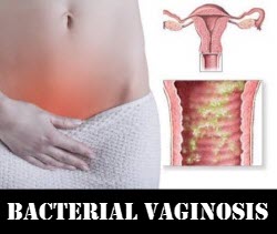 bacterial vaginosis treatment