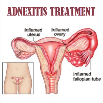 Adnexitis Treatment with Antibiotics