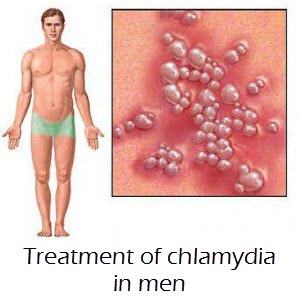 treatment of chlamydia in men