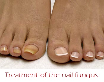 treatment of nail fungus
