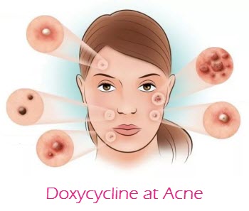 Doxycycline at Acne