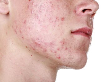 pimples and acne