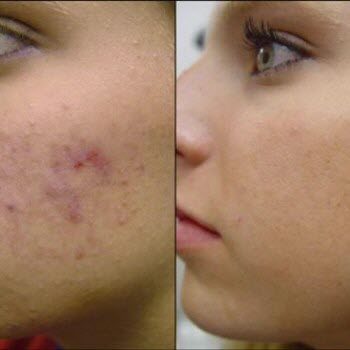 Doxycycline for acne: before and after