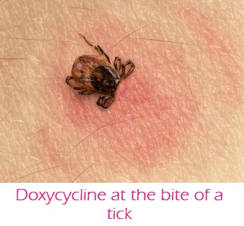 Doxycycline at the bite of a tick
